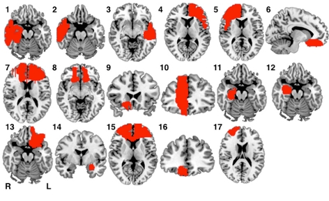 Hirnbilder: Verletzungen im neuronalen Netzwerk