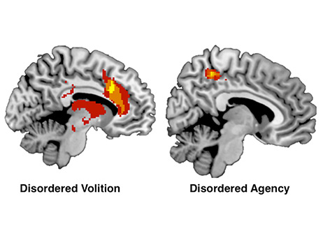 Regionen im menschlichen Gehirn, die mit Störungen des Willens einhergehen