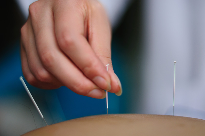 Frau sticht Akupunkturnadeln in die Haut eines Patienten