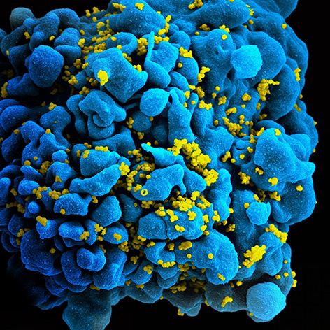 Mikroskopische Aufnahme: HIV-infizierte Immunzelle mit Rezeptoren an der Oberfläche