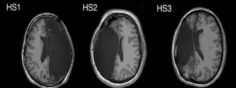 Gehirnscan: Bilder von halbseitig amputierten Gehirnen